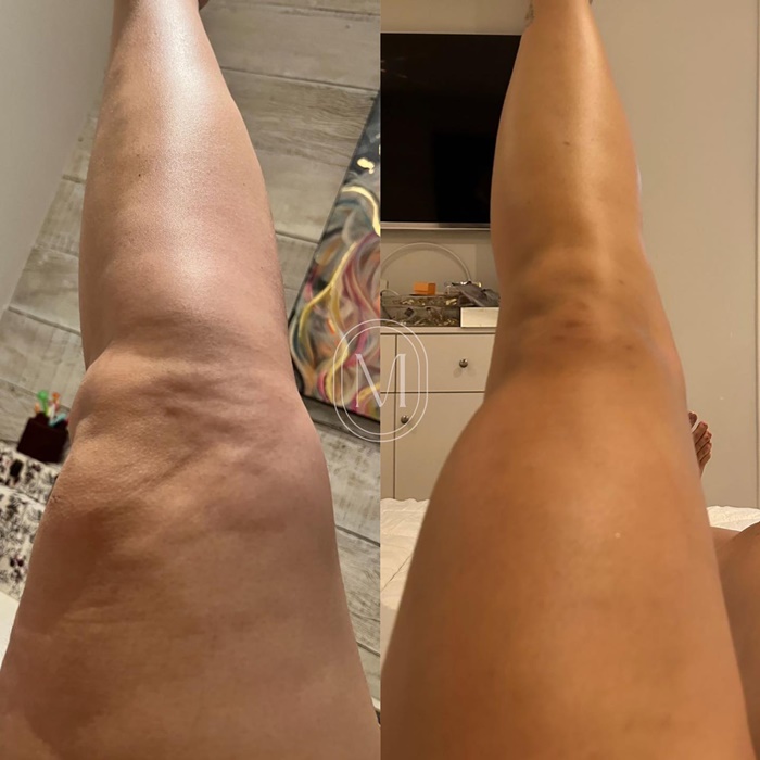 lipedema-antes-e-depois03