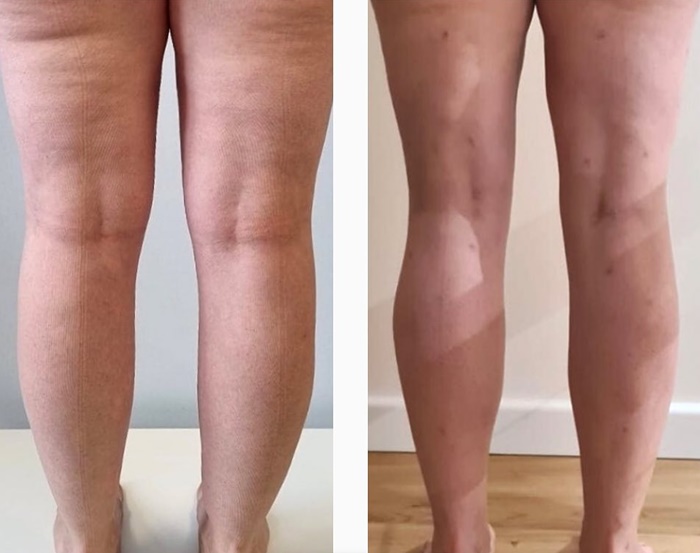 lipedema-antes-e-depois08