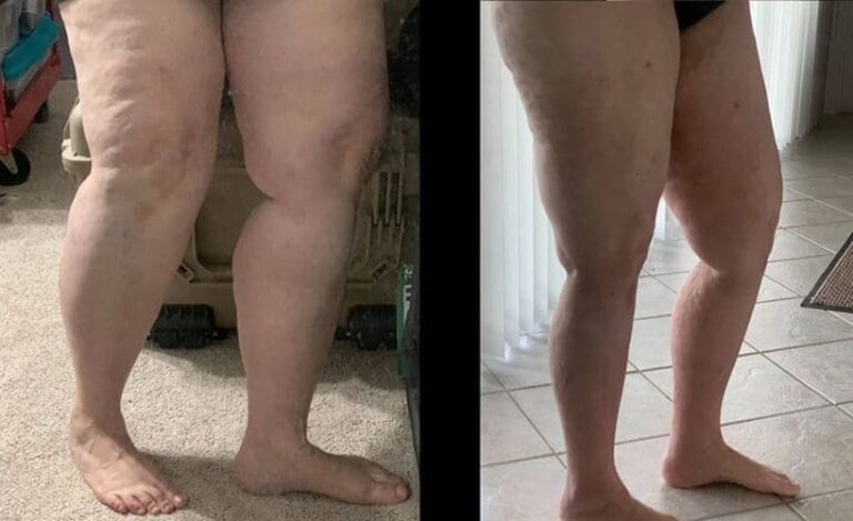 lipedema-antes-e-depois17