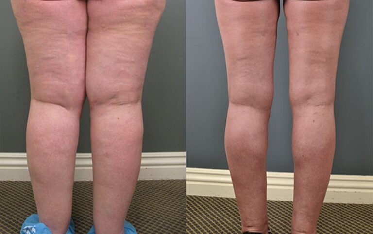 lipedema-antes-e-depois19